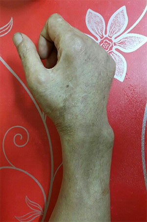▲ 현재 김씨의 오른손. 손목 윗부분 근육이 점점 사라지고 있다.